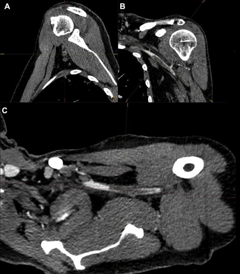 This diagnostic image set consists of three Computed Tomography Angiography (CTA) views of the left upper extremity and shoulder region, demonstrating vascular pathology in a clinical context of COVID-19-related thrombosis.