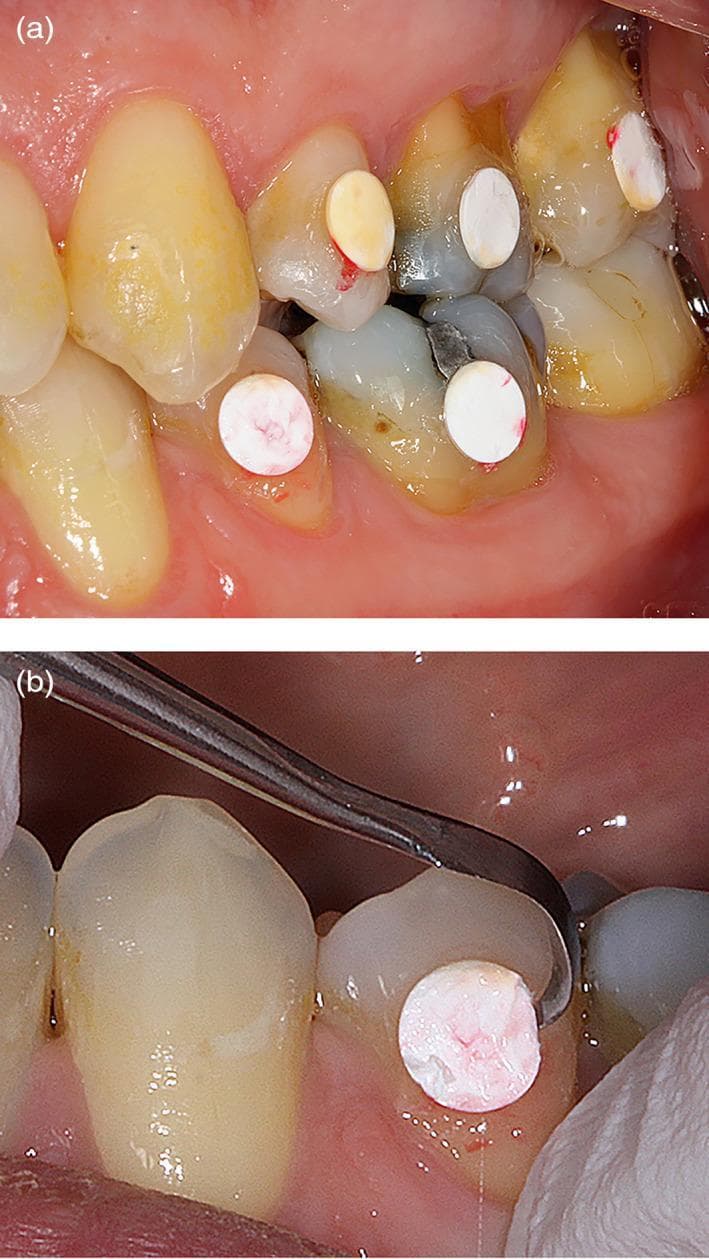 Two-panel clinical intraoral photograph demonstrating an experimental dental study on plaque accumulation. Panel (a) shows the buccal surfaces of maxillary and mandibular teeth (premolars and molars) with several white, circular expanded polytetrafluoroethylene (e-PTFE) membrane discs bonded to the enamel. The teeth exhibit natural yellowish staining, dark amalgam restorations, and mild gingival inflammation near the cervical margins. Panel (b) provides a close-up view of the mechanical retrieval process. A curved metal dental instrument, such as a scaler or probe, is positioned to carefully detach a single membrane disc from the buccal surface of a mandibular tooth. The retrieved membrane shows a slight reddish-pink discoloration, representing 4 hours of early biofilm formation and potentially accumulated oral fluids. The image illustrates a methodology for in vivo biofilm sampling and microbiological analysis in periodontology and dental research.