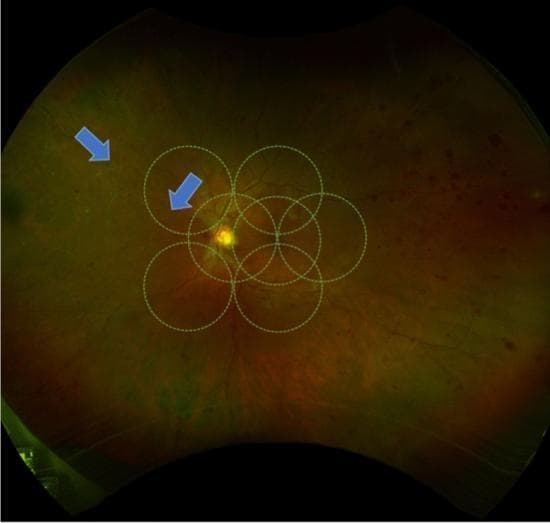 This ultra-widefield (UWF) pseudocolor fundus photograph illustrates advanced diabetic retinopathy in a human eye. The central retina is overlaid with a standardized template of seven overlapping dashed circles, representing the Early Treatment Diabetic Retinopathy Study (ETDRS) 7-standard fields used for clinical grading. The primary pathology demonstrated is peripheral retinal vessel whitening, indicated by blue arrows in the superotemporal quadrant. This whitening signifies vascular sheathing or sclerosis, often associated with chronic ischemia. The background fundus shows a variegated orange-red appearance with visible intraretinal hemorrhages and microvascular abnormalities characteristic of proliferative diabetic retinopathy (PDR). The image highlights the diagnostic utility of UWF imaging in identifying peripheral vascular changes that occur beyond the traditional 30-to-45-degree field of view of conventional fundus photography. These peripheral findings are clinically significant as they may correlate with areas of capillary non-perfusion and increased risk of disease progression.