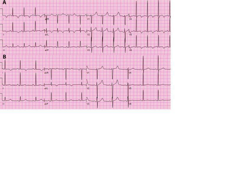 This comparative diagnostic image displays two 12-lead electrocardiogram (ECG) strips, labeled A and B, illustrating the cardiac manifestations of hypomagnesemia and its subsequent resolution. Panel A shows a baseline ECG characterized by a prolonged QT interval and significant T-wave inversions, most prominent in the lateral precordial leads (V5, V6) and lead II. These findings are classic markers of electrolyte-induced repolarization abnormalities. Panel B demonstrates the ECG following magnesium supplementation, showing a restoration of normal repolarization. Key changes include the shortening of the QT interval back toward a physiological range and the conversion of previously inverted T-waves to an upright, normal morphology in the lateral leads. The comparison highlights the critical role of magnesium in myocardial electrical stability and is a valuable educational tool for identifying reversible causes of QT prolongation and ST-T segment changes in clinical practice.