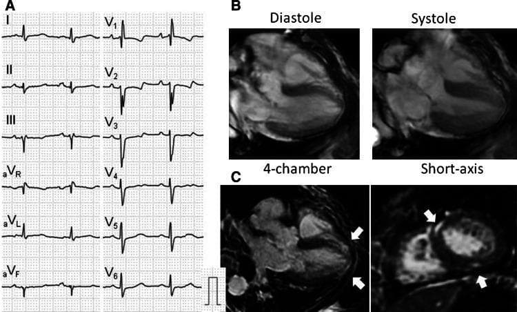 This composite educational image illustrates cardiac diagnostic findings in a 67-year-old female with systemic sclerosis (SSc). Panel (a) presents a 12-lead electrocardiogram (ECG) demonstrating a complete right bundle branch block (RBBB) and left axis deviation. Panel (b) shows Cine-Cardiac Magnetic Resonance (Cine-CMR) frames in the 4-chamber view during diastole and systole, exhibiting normal left ventricular (LV) volume and preserved global systolic function. Panel (c) features Late Gadolinium Enhancement CMR (LGE-CMR) in 4-chamber and short-axis views. White arrows highlight areas of pathological hyperenhancement, indicating myocardial fibrosis. The enhancement displays both striated and patchy patterns localized within the mid-myocardium, specifically at the anterior right ventricular (RV) insertion point and the inferior LV wall. This case highlights the role of multi-modal cardiac imaging in detecting subclinical myocardial involvement and replacement fibrosis in connective tissue diseases like SSc, even when ventricular function appears normal on cine imaging.