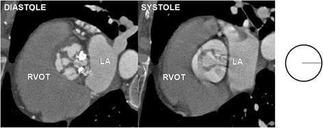 This diagnostic image consists of two axial computerized tomography (CT) scans and a supporting schematic diagram illustrating a rare unicuspid aortic valve (UAV). The CT images represent the heart during diastole (left) and systole (right). In the systolic frame, the aortic valve is seen as a single, lunar-shaped (teardrop) leaflet with only one visible commissure attached to the aortic wall. This morphology results in a significantly restricted, eccentric orifice area, which is a classic visual finding of severe valvular stenosis. Key anatomical landmarks are labeled, including the right ventricular outflow tract (RVOT) and the left atrium (LA). A line diagram to the right summarizes the single-commissure 'uncommissural' architecture. This visual material is used in cardiovascular radiology and cardiology education to differentiate congenital unicuspid variants from more common bicuspid or tricuspid aortic valve morphologies and to demonstrate the anatomical basis for early-onset aortic stenosis.