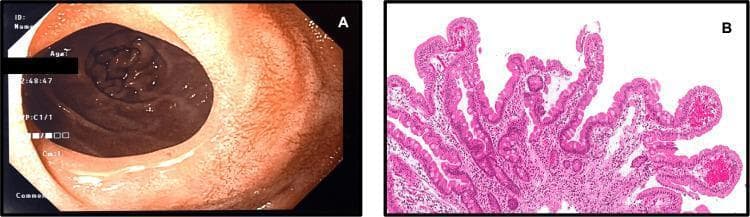 Educational medical composite featuring endoscopic and histological views of the duodenum post-treatment for celiac disease. Image A shows a clinical endoscopic view of the second part of the duodenum. The lumen is patent and unobstructed, indicating resolution of a prior stricture. The mucosal surface appears healthy with visible circular folds (plicae circulares) and no evidence of scalloping or atrophy. Image B is a high-power light microscopy image of a duodenal biopsy stained with Hematoxylin and Eosin (H&E). It demonstrates normal villous architecture consistent with a Marsh 0 classification. The villi are elongated, slender, and finger-like with a normal villus-to-crypt ratio. The epithelial lining is intact, and the lamina propria contains a normal distribution of cellular components without significant lymphocytic infiltration or blunting. Collectively, these images illustrate the successful mucosal and structural healing of the small intestine following a gluten-free diet and mechanical intervention.