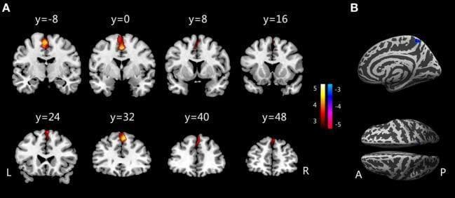 This diagnostic image displays neuroimaging findings comparing brain structures between children with primary monosymptomatic nocturnal enuresis (PMNE) and healthy controls. Section A presents a series of eight axial brain slices (labeled y=-8 to y=48) showing T1-weighted structural templates with heat map overlays. The orange-yellow clusters indicate regions of significantly increased gray matter volume (GMV), predominantly localized in the medial frontal regions, including the supplementary motor area (SMA) and medial prefrontal cortex (PFC). Section B illustrates a cortical surface rendering (gyrification index map) from a sagittal and dorsal perspective. A localized blue-shaded area on the right posterior hemisphere (right precuneus) represents a region of significantly decreased gyrification indices (GI) in the PMNE group. A color scale indicates statistical t-values, where positive values (red/yellow) denote increased GMV and negative values (blue/purple) denote decreased GI. The image provides clinical evidence of structural brain alterations in the central nervous system pathways potentially related to bladder control in pediatric enuresis.