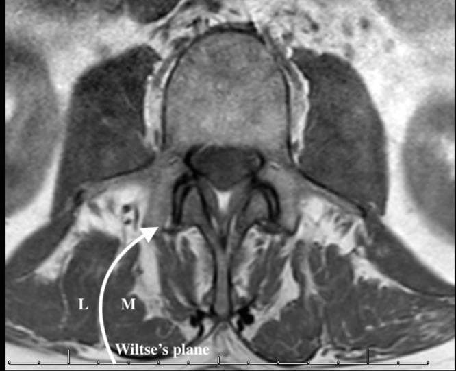 This diagnostic image is an axial slice from a Magnetic Resonance Imaging (MRI) scan of the lumbar spine, focusing on the posterior paraspinal musculature. The image demonstrates the anatomy relevant to the Wiltse (paraspinal) surgical approach. Key anatomical structures labeled include the multifidus muscle (M), which is positioned medially against the spinous process and lamina, and the longissimus muscle (L), part of the erector spinae group, situated more laterally. A prominent curved white arrow and line indicate Wiltse's plane, the natural avascular fascial cleavage interval between the multifidus and longissimus muscles. The MRI shows intermediate signal intensity for the muscle bellies and high signal intensity (bright) representing intermuscular fat and fascial layers, which clearly delineate the cleavage plane. Centrally, the vertebral body, spinal canal, and posterior elements are visible. This visual serves as an educational guide for spinal surgeons to identify the surgical trajectory for minimally invasive transforaminal lumbar interbody fusion (TLIF) or pedicle screw placement.