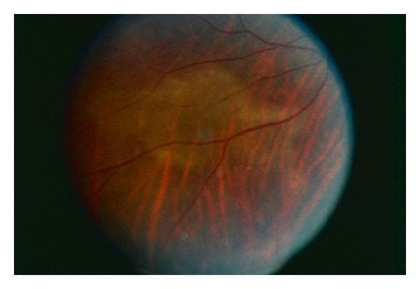 This clinical fundus photograph depicts the right eye of a patient with Acute Posterior Placoid Polymorphous Syphilitic Chorioretinitis (ASPPC), a rare ocular manifestation of secondary syphilis. The image demonstrates a characteristic large, circular, yellowish-white, placoid lesion at the level of the retinal pigment epithelium (RPE) and inner choroid, centrally located within the posterior pole. The surrounding retina displays a reddish-orange hue with visible retinal vasculature. Notably, several retinal vessels traversing the central lesion appear attenuated or partially obscured by the overlying inflammatory process. In the lower half of the fundus, there are linear, reddish streaks and subtle pigmentary changes radiating toward the periphery. The image illustrates the classic 'placoid' variant of syphilitic uveitis, emphasizing the importance of screening for Treponema pallidum in patients presenting with atypical posterior uveitis or placoid chorioretinal lesions.