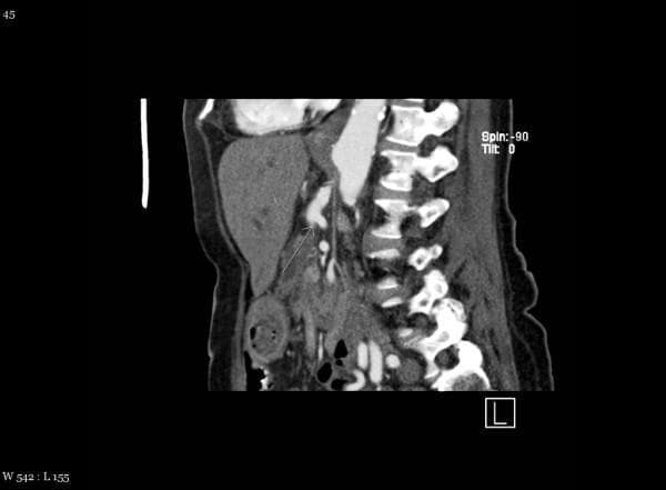 This diagnostic image is a contrast-enhanced sagittal CT scan of the abdomen, specifically focusing on the vascular anatomy and the vertebral column. The image demonstrates a rare anatomical variant where the superior mesenteric artery (SMA) originates from the celiac axis rather than directly from the abdominal aorta. A white arrow points to this common celiac-mesenteric trunk, showing the joint origin and the subsequent anterior descent of the SMA. Visible landmarks include the hyperdense vertebral bodies and intervertebral discs of the lumbar spine, the abdominal aorta running anterior to the spine, and portions of the liver and gastrointestinal tract with varying soft tissue densities. This clinical imaging is essential for preoperative surgical planning, particularly in pancreatic or hepatobiliary procedures, as the variant significantly alters the vascular supply to the midgut. The educational focus is on identifying vascular anomalies and understanding their relationship to the central abdominal organs.