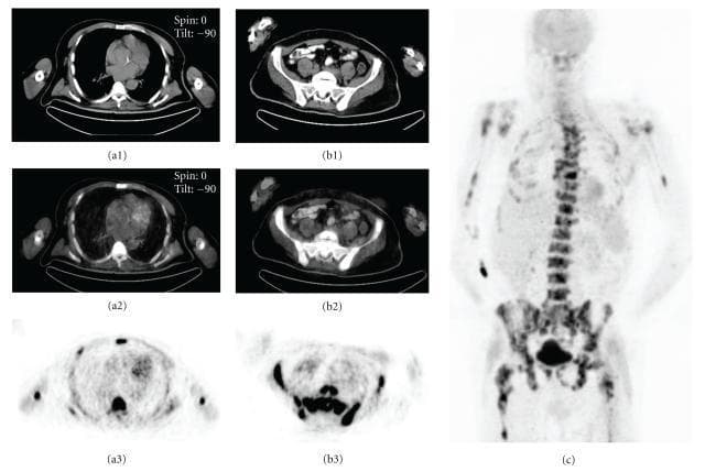 This diagnostic image set showcases a multi-modal PET/CT study of a 58-year-old male presenting with fever of unknown origin (FUO). The panel includes transaxial CT (a1, b1), fused PET/CT (a2, b2), and PET (a3, b3) slices at the thoracic and pelvic levels, alongside a full-body anterior Maximum Intensity Projection (MIP) image (c). The imaging demonstrates intense, diffuse FDG (fluorodeoxyglucose) uptake localized to the bone marrow compartments. The MIP image (c) highlights a prominent, systemic distribution of radiotracer accumulation throughout the axial skeleton, including the vertebrae and pelvis, and the proximal appendicular skeleton, specifically the humeri and femora. Notably, there is a lack of significant extraosseous metabolic activity. This visual pattern of skeletal FDG-avid disease is characteristic of hematologic malignancies involving the marrow. In this clinical context, the findings were diagnostic of non-Hodgkin's lymphoma. The comparison between modalities illustrates the utility of fusion imaging in providing precise anatomical localization of metabolic abnormalities identified on PET.