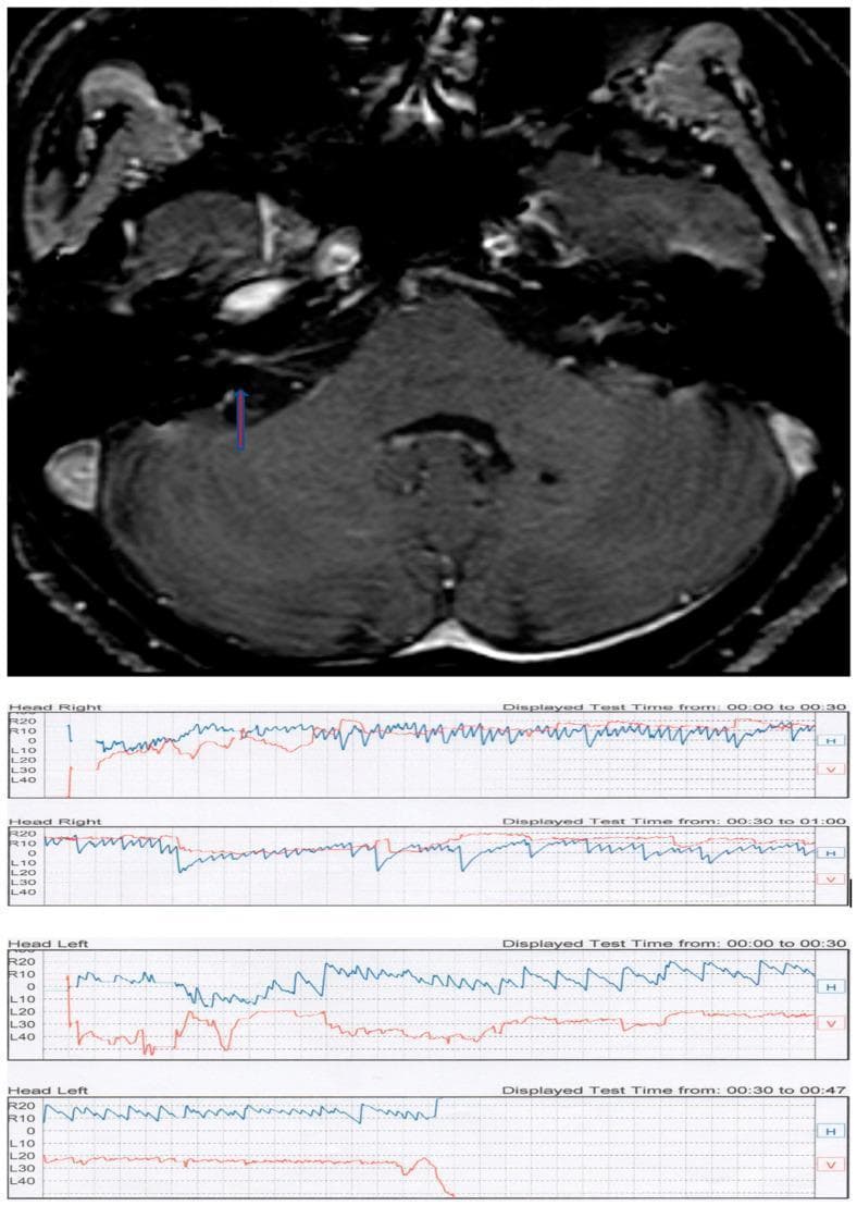 This composite educational figure illustrates the diagnostic findings for a patient with positional vertigo. The top panel features an axial T1-weighted contrast-enhanced MRI scan of the posterior fossa. A blue arrow highlights a small, enhancing lesion within the right internal auditory canal, diagnostic of an intrameatal acoustic neuroma (vestibular schwannoma). The bottom panel contains multiple videonystagmography (VNG) tracings from a Pagnini-McClure positional test. The recordings show horizontal (H, blue line) and vertical (V, red line) eye movements during 'Head Right' and 'Head Left' maneuvers. The tracings demonstrate apogeotropic direction-changing positional nystagmus characterized by rapid, paroxysmal horizontal oscillations. The VNG evidence of central-type positional nystagmus combined with MRI findings demonstrates how a peripheral nerve tumor can manifest with atypical positional vertigo, mimicking or complicating Benign Paroxysmal Positional Vertigo (BPPV) clinical presentations.