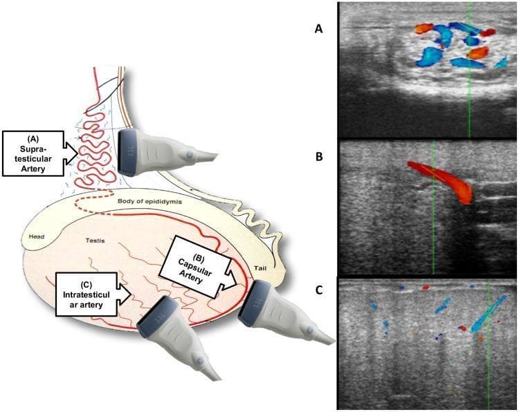 This composite educational graphic details the ultrasonographic assessment of testicular blood flow, combining an anatomical illustration with corresponding color Doppler images. The left panel features a diagram of the male reproductive anatomy, including the testis, epididymis (head, body, and tail), and spermatic cord, indicating three key vascular landmarks and transducer positions. The right panel displays three color Doppler ultrasound frames labeled A, B, and C. Frame A shows the supra-testicular artery (SA) in the spermatic cord, characterized by a complex cluster of tortuous vessels with mixed red and blue signals against a medium-gray B-mode background. Frame B depicts the capsular artery (CA) near the tail of the epididymis, showing a more linear, prominent vessel with a uniform red signal. Frame C illustrates intratesticular arteries (IA) within the testicular parenchyma, appearing as small, dispersed punctate signals within a heterogeneous, speckled echogenic background. This visual serves to teach the mapping and physiological flow characteristics of the testicular arterial supply for diagnostic purposes in reproductive medicine.