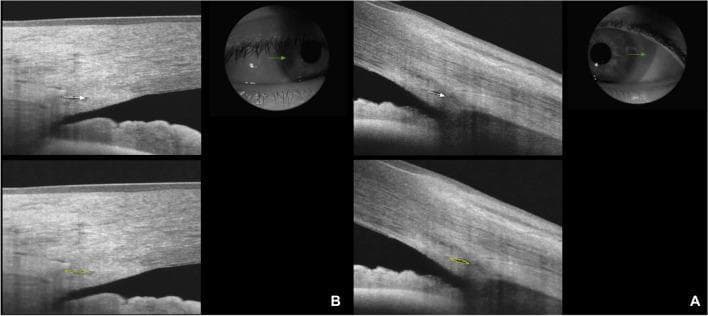 This diagnostic image set showcases Optical Coherence Tomography (OCT) of the anterior segment, specifically focusing on the iridocorneal angle and Schlemm’s canal (SC). The images compare a healthy control (Panel B) with a patient (Panel A). The cross-sectional OCT scans visualize the corneal stroma, the scleral spur, and the trabecular meshwork. Schlemm’s canal is identified as a thin, black, hypo-reflective lumen located external to the trabecular meshwork. In the healthy subject (B), the canal lumen is clearly visible and elongated, highlighted by a yellow outline in the lower-magnification view to demonstrate the Schlemm’s canal area (SCA). In the patient image (A), the SC lumen appears significantly smaller, narrower, and more compressed, indicating a reduction in both length and area. Accompanying clinical infrared photographs illustrate the probe positioning at the temporal limbus during the 3.0 mm line scan acquisition. This comparison is clinically relevant for ophthalmological studies involving aqueous humor outflow resistance and conditions such as glaucoma or Graves' ophthalmopathy.