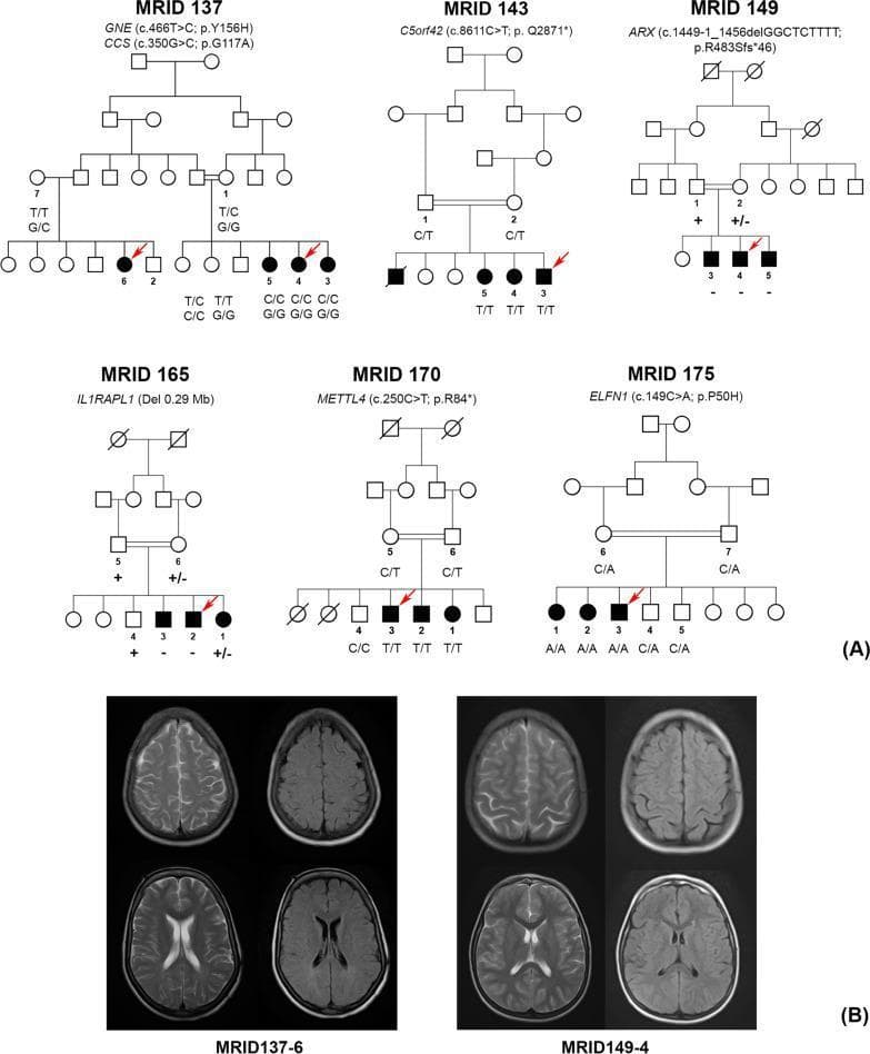 This composite educational image consists of two primary sections: genomic pedigrees (A) and diagnostic neuroimaging (B), relating to intellectual disability research.
Section A displays six multi-generational pedigrees (MRID 137, 143, 149, 165, 170, and 175) demonstrating autosomal recessive and X-linked inheritance patterns. Each pedigree includes specific genetic variant notation (e.g., GNE p.Y156H, ARX p.R483Sfs*46) and segregation results for individuals available for study. Red arrows indicate probands selected for whole-exome sequencing.
Section B presents axial non-contrast MRI brain scans for patients MRID137-6 and MRID149-4. Both patients exhibit mildly prominent sulci in the parietal regions and age-appropriate ventricular size. In patient MRID137-6, subtle hyperintense lesions are visible in the periventricular white matter on T2-weighted/FLAIR sequences, whereas MRID149-4 shows relatively normal white matter signal. The images serve to correlate specific genetic variants with visible neuroanatomical features in Pakistani families with intellectual disabilities.
