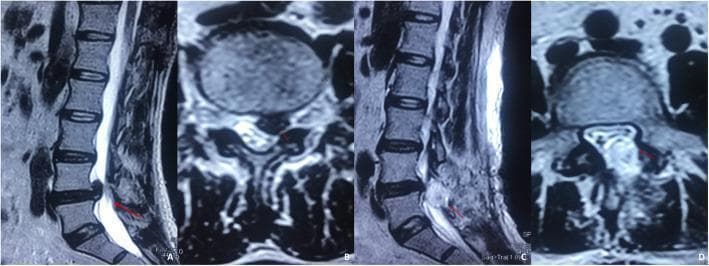 This composite diagnostic image features four MRI views (T2-weighted sequence) of the lumbar spine, specifically focusing on the L4/L5 segment in a 37-year-old male. Panels (A) and (B) demonstrate preoperative lumbar disc herniation. Panel (A), a sagittal view, shows a large posterior herniation of the L4/L5 intervertebral disc significantly encroaching upon the spinal canal. Panel (B), a transverse view, displays the herniated nucleus pulposus lateralized to the left, causing direct compression of the left exiting nerve root. Panels (C) and (D) illustrate postoperative complications following discectomy. Panel (C), a sagittal view, reveals an accumulation of altered signal intensity posterior to the L4/L5 disc space, consistent with a symptomatic postoperative epidural hematoma. Panel (D), an axial view, demonstrates this hematoma occupying the epidural space, resulting in mass effect with marked compression and displacement of the dural sac and the left nerve root. Red arrows highlight the specific sites of herniation and subsequent hematoma-induced compression, serving as a clinical example of postoperative spinal epidural hematoma (SEH).