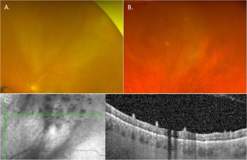 This composite figure illustrates the multimodal clinical presentation of ocular syphilis, specifically punctate inner retinitis.