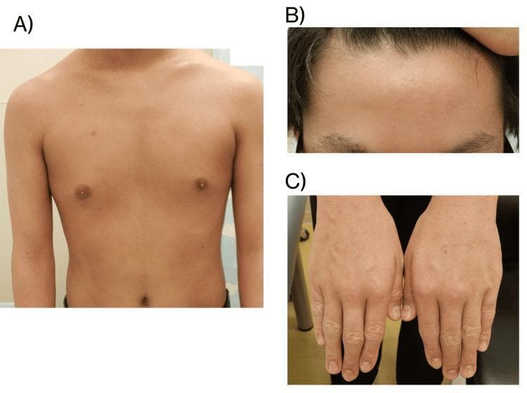 This composite clinical photograph displays the dermatologic status of a 14-year-old male patient following four weeks of upadacitinib treatment for atopic dermatitis. Image A provides an anterior view of the torso (chest and abdomen), showing significant resolution of previously active eczema, with even skin tone and absence of acute inflammatory lesions, lichenification, or excoriations. Image B is a close-up of the forehead and hairline, demonstrating clear skin without erythema or scaling. Image C shows the dorsal aspect of both hands; while the skin appears largely improved, there is evidence of mild residual xerosis (dryness), accentuated skin markings, and faint post-inflammatory pigmentary changes over the metacarpophalangeal joints. These images illustrate a positive clinical response to JAK inhibitor therapy, correlated with a low Eczema Area and Severity Index (EASI) score of 0.6, indicating near-complete skin clearance. The visual evidence serves as an educational example of therapeutic progression and disease management in pediatric atopic dermatitis.