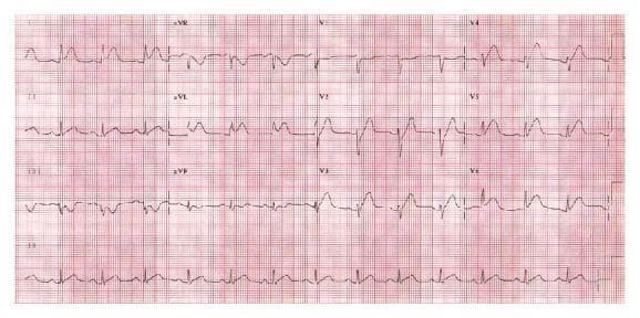 A 12-lead electrocardiogram (ECG) displayed on standard red grid paper, demonstrating acute anterolateral myocardial injury. The diagnostic image reveals significant ST-segment elevation across the precordial leads V1 through V6, as well as in the high lateral leads I and aVL. The ST segments in the anterior leads (V1-V4) exhibit a distinct convex upward (coving) morphology. Accompanying the ST elevation are tall, hyperacute, peaked T waves, most prominent in the precordial leads. There is evidence of reciprocal ST-segment depression in the inferior leads (II, III, and aVF). The rhythm is tachycardic, and the overall findings are consistent with an acute ST-elevation myocardial infarction (STEMI) involving the territory of the left anterior descending artery. This ECG serves as a critical clinical teaching tool for identifying myocardial ischemia and injury patterns in acute coronary syndromes.