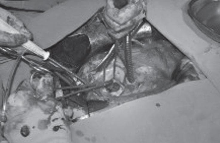 This grayscale clinical photograph provides an intraoperative view during a redo cardiac surgery, specifically a mitral valve replacement (MVR). The surgical field is exposed via a resternotomy and a left atriotomy, revealing the mitral position. Central to the image is a mechanical prosthetic valve that is visibly obstructed by a dense, adhesive thrombotic mass, characteristic of prosthetic valve thrombosis (PVT). This pathological finding results in a 'stuck' valve with immobile or restricted leaflets. Various surgical instruments, including retractors and forceps, are actively manipulating the tissue to provide exposure. Additionally, cardiopulmonary bypass (CPB) components, such as suction cannulae and perfusion tubing, are visible within the operative field. This image serves as an educational example of mechanical valve complications and the surgical approach required for emergency thrombectomy or redo valve replacement in the context of acute valve failure.