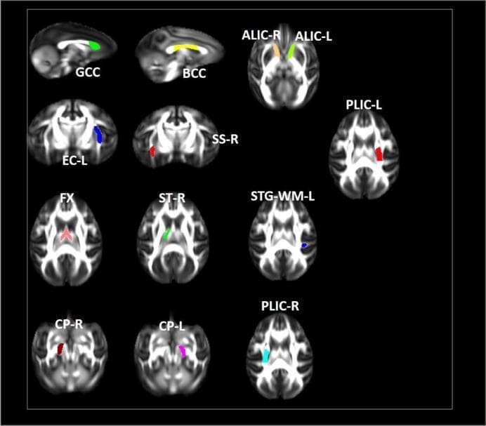 Anatomical diagram and diagnostic images of a non-human primate brain (rhesus macaque), specifically displaying fractional anisotropy (FA) maps derived from diffusion tensor imaging (DTI). The image shows multiple sagittal and axial brain slices with colored regions of interest (ROIs) identifying key white matter tracts. Midline structures include the genu of the corpus callosum (GCC, green), body of the corpus callosum (BCC, yellow), and fornix (FX, red). Lateralized tracts include the anterior limb of the internal capsule (ALIC-R/L, orange and green), posterior limb of the internal capsule (PLIC-L/R, red and cyan), external capsule (EC-L, blue), sagittal striatum (SS-R, red), stria terminalis (ST-R, green), superior temporal gyrus white matter (STG-WM-L, blue), and cerebral peduncles (CP-R/L, red and magenta). This educational visual illustrates the localization of neuroanatomical structures used to study microstructural white matter changes in a simian immunodeficiency virus (SIV) model of neuroHIV and the effects of antiretroviral therapy (cART).