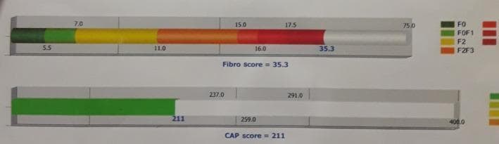 A diagnostic graphical output from a transient elastography (FibroScan) assessment used to evaluate liver stiffness and steatosis. The image features two horizontal bar graphs. The top bar represents the 'Fibro score' (liver stiffness in kilopascals, kPa), showing a color-coded gradient corresponding to Metavir fibrosis stages: dark green (F0), light green (F0F1), yellow (F2), orange (F2F3), and red (F4/cirrhosis). A specific value of 35.3 kPa is highlighted, indicating advanced cirrhosis. The lower bar represents the 'Controlled Attenuation Parameter (CAP) score' (measured in dB/m) used to quantify hepatic steatosis. This bar shows a green segment reaching a value of 211 dB/m on a scale up to 400.0, suggesting a low level of fat accumulation (S0). The graphic is a standard clinical tool in gastroenterology and hepatology for non-invasive monitoring of chronic liver disease, providing a visual comparison between fibrosis severity and steatosis levels.