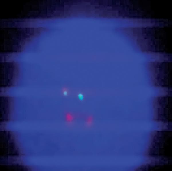 A diagnostic microphotograph of a peripheral blood interphase cell from a patient with Chronic Myeloid Leukemia (CML), analyzed via Fluorescence In Situ Hybridization (FISH). The image demonstrates an atypical BCR-ABL1 translocation pattern using a dual-color, dual-fusion probe. Against the dark blue DAPI-stained nuclear background, four distinct fluorescent signals are visible. The observed configuration is classified as 1F1G2R: one orange/yellow fusion signal (representing the BCR-ABL1 hybrid on the derivative chromosome 22), one green signal (representing the native BCR locus on chromosome 22), and two red signals (representing the native ABL1 locus on chromosome 9). This atypical pattern deviates from the standard 2F1G1R fusion signal usually seen in Philadelphia chromosome-positive cells, indicating clonal evolution or complex chromosomal rearrangements. This image serves as an educational example of cytogenetic variability in hematologic malignancies and the use of FISH for monitoring molecular response in patients undergoing tyrosine kinase inhibitor (TKI) therapy like imatinib.