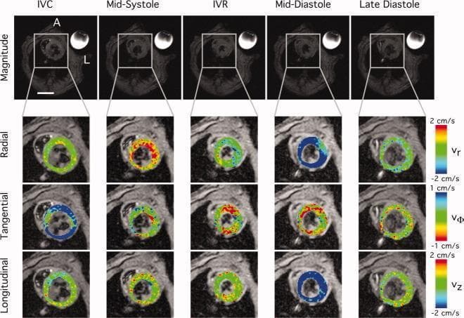 This diagnostic composite shows mid-ventricular Tissue Phase Mapping (TPM) MRI of a heart across five cardiac phases: Isovolumetric Contraction (IVC), Mid-Systole, Isovolumetric Relaxation (IVR), Mid-Diastole, and Late Diastole. The top row displays magnitude images showing the left ventricle's (LV) morphology, where the lumen decreases in size during mid-systole and expands toward late diastole. The subsequent three rows provide color-coded velocity maps for myocardial motion analysis. The Radial Velocity (Vr) row uses a red-to-blue scale (2 to -2 cm/s), illustrating peak contraction (red) in mid-systole and relaxation (blue) in mid-diastole. The Tangential Velocity (Vφ) row (1 to -1 cm/s) depicts rotational mechanics, showing clockwise rotation (blue) during IVC and counter-clockwise rotation (red/yellow) during mid-systole/IVR. The Longitudinal Velocity (Vz) row (2 to -2 cm/s) tracks base-to-apex motion, with red indicating systolic shortening and blue indicating diastolic lengthening. These images facilitate the assessment of transmural wall motion and regional myocardial strain, particularly relevant for diagnosing ischemia or cardiomyopathy.
