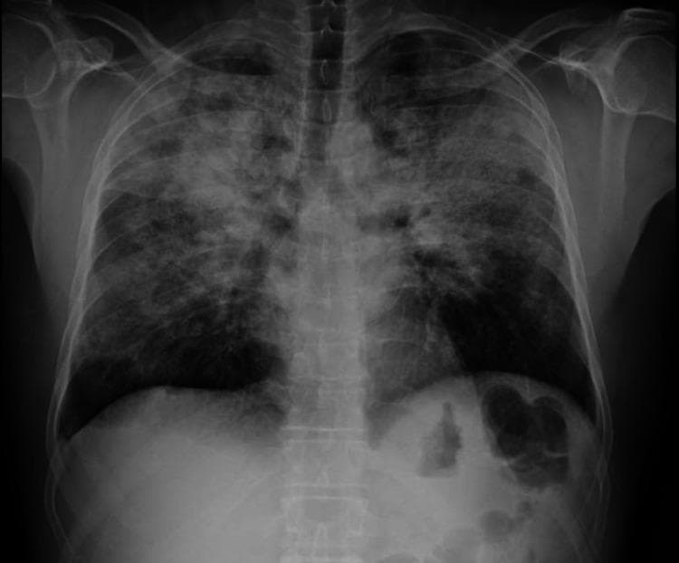 A posterior-anterior (PA) chest x-ray demonstrating extensive, bilateral, multifocal opacities. The primary finding is the presence of several foci of consolidation and ground-glass densities scattered throughout the lung parenchyma, with a notable predominance in the upper and middle lung zones and towards the periphery. These opacities are ill-defined and patchy, characteristic of alveolar filling processes. The cardiac silhouette, mediastinal contours, and hila appear within normal limits. The trachea is midline, and there is no evidence of significant pleural effusion or pneumothorax. The diaphragmatic domes are clear, and the lung volumes are preserved. In the clinical context of asthma and peripheral eosinophilia, these radiographic features are consistent with Chronic Eosinophilic Pneumonia (CEP), highlighting the ‘photonegative’ of pulmonary edema pattern where opacities are peripheral rather than central. This image serves as a key diagnostic example for radiological evaluation of eosinophilic lung diseases.