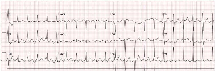 This diagnostic image is a standard 12-lead electrocardiogram (ECG) demonstrating a supraventricular tachyarrhythmia. The most prominent finding is a classic 'sawtooth' pattern of atrial activity, most visible in inferior leads II, III, and aVF, characteristic of atrial flutter. The ventricular rate is rapid and irregularly irregular, indicating atrial flutter with variable conduction. The QRS complexes are narrow (measured at 85 ms), indicating a supraventricular origin of the rhythm. There is no evidence of acute ST-segment elevation or depression, and T-wave morphology appears normal across all leads. The QTc is reported as 377 ms, within normal physiological limits. This visual serves as a clinical teaching tool for identifying typical atrial flutter with rapid ventricular response (RVR) and distinguishing it from other tachyarrhythmias such as atrial fibrillation or ventricular tachycardia. It is relevant for cardiology training and acute care medicine.