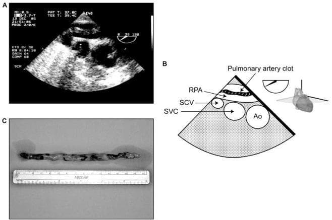 This composite educational image illustrates acute pulmonary embolism and its subsequent surgical management. Panel A is a transesophageal echocardiogram (TEE) demonstrating a heterogeneous, echogenic mass within the right pulmonary artery (RPA), adjacent to the aorta (Ao) and superior vena cava (SVC). Panel B provides a labeled schematic diagram of the TEE view, identifying anatomical landmarks including the RPA, SVC, subclavian vein (SCV), and the specific location of the pulmonary artery clot. Panel C is a clinical photograph of the surgically removed specimen (embolectomy). The macroscopic specimen shows a long, organized thromboembolus, approximately 9-10 cm in length according to the included surgical ruler. The clot displays a variegated color ranging from dark red to tan, with a friable, irregular texture characteristic of a deep vein thrombosis that has embolized. The set is intended for advanced medical education focusing on cardiology, cardiothoracic surgery, and critical care, demonstrating the correlation between real-time diagnostic imaging and surgical pathology in hemodynamic instability.