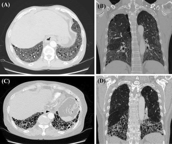 High-resolution computed tomography (HRCT) comparison of interstitial lung disease (ILD) patterns in systemic sclerosis (SSc). Figures A (axial) and B (coronal) display a Non-Specific Interstitial Pneumonia (NSIP) pattern characterized by bilateral, diffuse ground-glass opacities and mild traction bronchiectasis with a distinct basal predominance. Figures C (axial) and D (coronal) demonstrate a Usual Interstitial Pneumonia (UIP) pattern. This pattern is marked by extensive subpleural honeycombing (clusters of cystic airspaces), exuberant traction bronchiectasis, and severe architectural distortion predominantly involving the lower lung zones. These diagnostic images serve to illustrate the distinct radiologic morphology between NSIP and UIP patterns in patients with connective tissue disease-associated ILD, highlighting key features such as distribution, presence of honeycombing, and the degree of fibrotic changes essential for clinical classification and management.