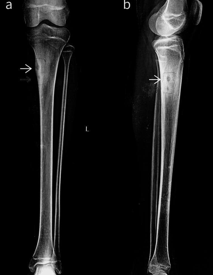 Anteroposterior (a) and lateral (b) plain X-ray radiographs of a left lower leg focusing on the knee and proximal tibial shaft. The diagnostic images demonstrate a multicentric bone lesion located within the proximal meta-diaphyseal region of the medial tibial cortex. Two distinct lytic nidi (indicated by white and dotted arrows) are visible, characterized by central radiolucency. These lesions are surrounded by significant reactive sclerosis, appearing as dense, opaque bone, along with associated cortical thickening (periosteal reaction). The anatomical alignment of the tibia and fibula remains normal, with the knee joint space preserved. These findings are highly characteristic of multicentric osteoid osteoma. This visual material is used in medical education to distinguish benign osteoid lesions and to illustrate the classic presentation of a nidus with surrounding sclerosis on conventional radiography.
