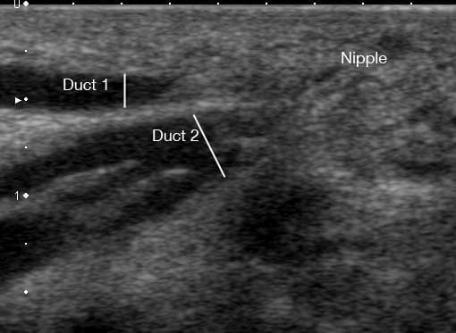 This diagnostic ultrasound image captures a sagittal view of milk ducts within a lactating human breast prior to milk ejection. The content demonstrates two distinct ductal structures, labeled Duct 1 and Duct 2, oriented toward the nipple region. Both ducts exhibit a characteristic sonographic appearance: hypoechoic (dark/black) internal lumens indicating fluid content (milk), bounded by echogenic (bright/white) walls. Duct 1 is positioned more superficially, measured at a depth of 1.95 mm from the skin surface, appearing as a single, linear tubular structure. Duct 2 is located deeper at 3.72 mm and displays a complex branching pattern where three separate tributary ducts are seen merging into a larger main channel. The surrounding breast parenchyma shows heterogeneous echogenicity typical of functional mammary tissue. This image serves as an educational example of maternal breast anatomy during lactation, highlighting the use of non-invasive ultrasonography to monitor ductal dilation and branching morphology in a clinical or research setting.