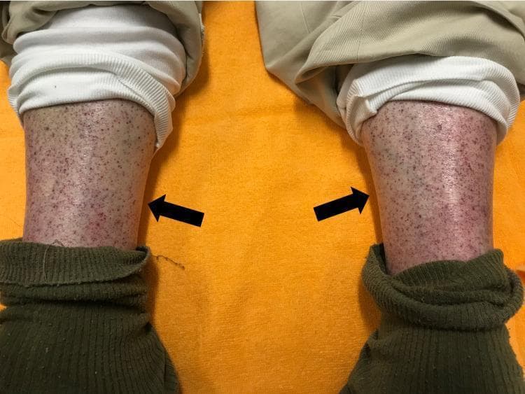 Clinical photograph of the bilateral lower extremities of an elderly male, demonstrating widespread cutaneous manifestations of a bleeding disorder. The image shows the anterior (pretibial) regions of both legs, featuring a dense distribution of non-blanching, pinpoint-sized reddish-purple spots consistent with petechiae. The lesions are multifocal and symmetric in their distribution across both shins. Two black arrows point toward the primary clusters of these hemorrhagic lesions. There is evidence of mild underlying erythema and possible trace edema in the affected skin. The visual presentation is highly characteristic of severe thrombocytopenia or small-vessel vasculitis, frequently associated with immune-mediated conditions such as Immune Thrombocytopenic Purpura (ITP) following triggers like recent viral vaccination. The patient's clothing (trousers and socks) is retracted to reveal the distal leg pathology, emphasizing the clinical importance of physical examination in detecting systemic hemostatic failure.