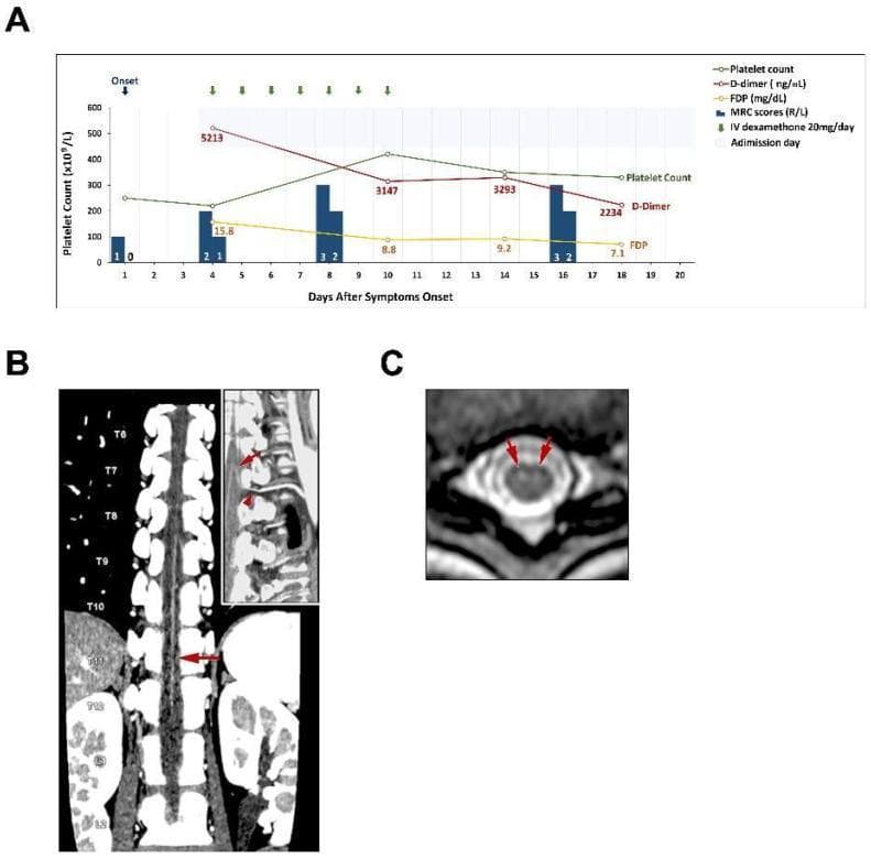 A multi-panel medical graphic illustrating clinical course and diagnostic imaging of a spinal cord infarction. Panel A is a line graph and bar chart summarizing clinical events over 20 days post-symptom onset, tracking platelet count, D-dimer, Fibrinogen Degradation Products (FDP), and Medical Research Council (MRC) muscle strength scores. Panel B shows a coronal maximum intensity projection (MIP) reconstruction of a CT angiography (CTA) image of the thoracolumbar region. An arrow points to tandem narrowing of the artery of Adamkiewicz (Aka) at the T10-11 level. An inset curved multiplanar reformatted image displays the artery's continuity from the left T9-10 lumbar artery and aorta around the vertebral arch pedicle. Panel C presents a T2-weighted axial MRI of the spinal cord at the T9-11 level, demonstrating focal hyperintensity (edema) in the central gray matter. Red arrows highlight bilateral high signal intensity in the ventral horns, forming the characteristic 'owl's eyes sign,' which is highly suggestive of anterior spinal artery syndrome or spinal cord ischemia.