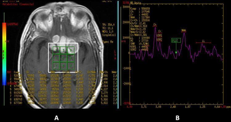 Educational medical graphic presenting Magnetic Resonance Spectroscopy (MRS) of the brain. Panel A shows an axial contrast-enhanced T1-weighted MRI of the brain, highlighting a multi-voxel grid (3x3 region of interest) placed over an intracranial extension in the anterior cranial fossa and suprasellar region. Panel B displays the corresponding MR spectrum, illustrating metabolite peaks at specific parts per million (ppm). The spectrum demonstrates a high Choline (Ch) peak, a stable Creatine (Cr) peak, and a significantly reduced N-acetylaspartate (NAA) peak. These findings result in an elevated Choline-Creatine (Ch/Cr) ratio and a decreased NAA/Cr ratio, characteristic of neoplastic or proliferative processes such as high-grade tumors or specific inflammatory lesions. A Lipid/Lactate (LL) peak is also visible at approximately 1.3 ppm. The display includes quantitative metabolite values and ratios for clinical correlation.