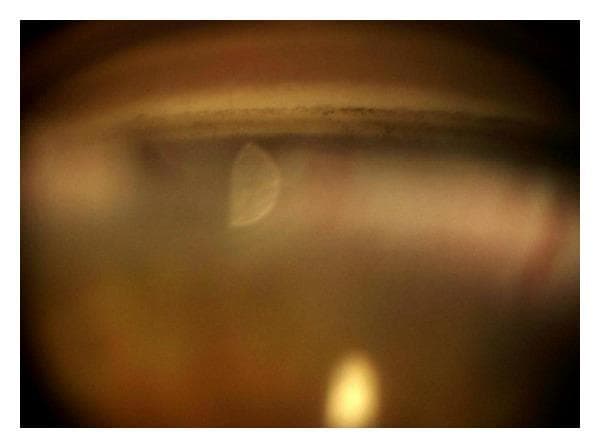 This diagnostic image is a clinical gonioscopy photograph showing the anterior chamber angle of a human eye. The image demonstrates a wide-open angle (Van Herick Grade 4 equivalent), where key anatomical landmarks are clearly visible. The prominent pigmented band across the superior portion of the angle corresponds to the trabecular meshwork, showing mild-to-moderate granular pigmentation. Adjacent anatomical structures including Schwalbe's line (superior to the meshwork) and the scleral spur (inferior to the meshwork) are discernible, indicating a deep angle recess. The iris root is positioned posteriorly, confirming the open configuration. Prominent light artifacts, including a crescent-shaped reflection in the center and a yellowish circular reflex at the bottom, are visible due to the slit-lamp and contact lens interface. This visual is typical for assessing glaucoma risk and pigmentation disorders such as pigmentary glaucoma or nevus of Ota-related ocular findings.