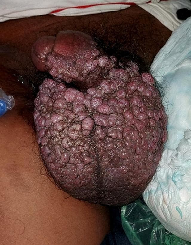 This clinical photograph displays a human male genital region exhibiting extensive multinodular lesions. The anatomical focus is the scrotum and the proximal shaft of the penis. The skin texture is significantly altered by the presence of numerous, densely packed, exophytic nodules. These individual lesions range from small papules to medium-sized nodules, many of which have a rounded or irregular morphology. Their color is predominantly a dark, purplish-red or violaceous hue, characteristic of vascular or infiltrative skin pathologies. The distribution is widespread and confluent, nearly entirely replacing the normal scrotal skin surface and extending onto the penile shaft. The clinical presentation is highly suggestive of advanced dermatological or systemic conditions such as Kaposi sarcoma, cutaneous lymphoma, or severe idiopathic scrotal calcinosis. This image serves as a teaching tool for medical students and clinicians to recognize atypical dermatological manifestations of internal or infectious diseases in the urogenital region.