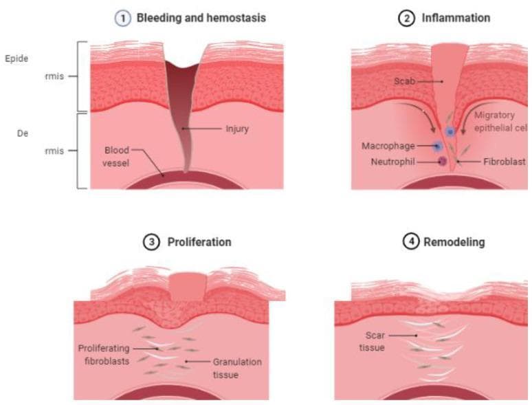 Anatomical diagram illustrating the four sequential phases of cutaneous wound healing: (1) Bleeding and Hemostasis, (2) Inflammation, (3) Proliferation, and (4) Remodeling. The cross-sectional illustrations represent the epidermis and dermis layers. Phase 1 shows a full-thickness injury penetrating through to the underlying blood vessel, depicting acute hemorrhage. Phase 2 (Inflammation) displays the formation of a surface scab, with arrows indicating the movement of migratory epithelial cells, alongside an infiltration of macrophages, neutrophils, and fibroblasts. Phase 3 (Proliferation) demonstrates the development of granulation tissue, characterized by proliferating fibroblasts and the reconstruction of the epidermal layer beneath the residual scab. Phase 4 (Remodeling) illustrates the final stage where the epidermis is fully restored, and the dermis contains organized scar tissue in place of the original injury site. This educational infographic provides a visual timeline of cellular responses and tissue structural changes during the natural course of human skin repair, useful for medical students and clinical practitioners studying pathophysiology.