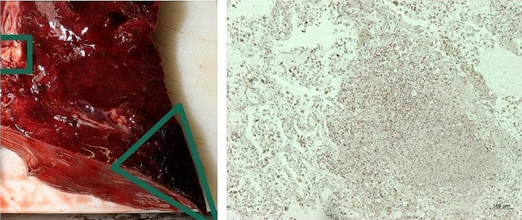 This composite educational image illustrates the pathological findings of a lung abscess and infarction through gross inspection and histology. The left panel shows a clinical photograph of a gross lung specimen. The tissue exhibits diffuse congestion and a dark red, hemorrhagic appearance. A green square highlights a localized lung abscess characterized by a paler, necrotic, and irregular surface texture. A green triangle identifies a wedge-shaped, dark, consolidated area consistent with a lung infarction, likely secondary to septic embolism. The right panel displays a corresponding histological section at 50x magnification using Chloroacetate Esterase (CAE) staining. The microscopy reveals a dense septic focus with heavy neutrophilic infiltration and disorganized cellular architecture, characteristic of acute inflammatory response and tissue liquefaction. A 100-micrometer scale bar is provided for reference. This material is significant for pathology and forensic medicine in demonstrating the pulmonary complications of systemic sepsis or infective endocarditis.