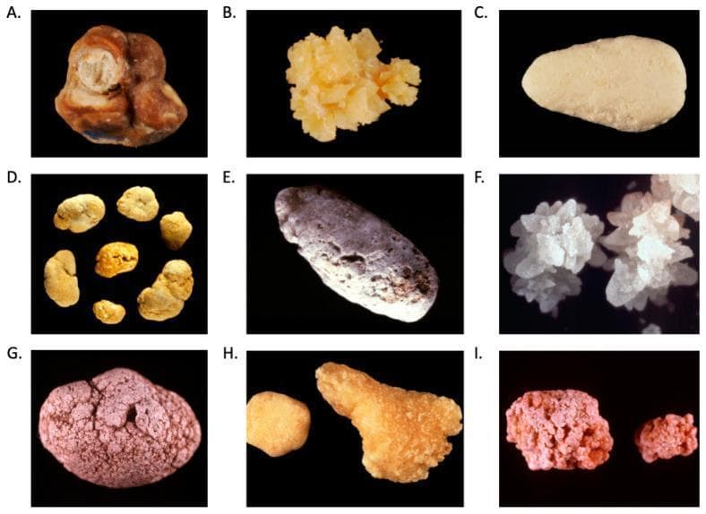 A multi-panel clinical photograph displaying a comparison chart of nine distinct kidney stone (nephrolithiasis) subtypes, labeled A through I. The specimens demonstrate significant morphological variation based on chemical composition. (A) Calcium oxalate monohydrate (Whewellite): brown, multi-lobed stone with concentric layers. (B) Calcium oxalate dihydrate (Weddellite): yellowish, sharp bipyramidal crystals. (C) Calcium phosphate (carbapatite): smooth, oval, light tan specimen. (D) Uric acid: small, rounded, yellowish-orange stones. (E) Ammonium urate: elongated, greyish stone with surface staining. (F) Struvite (triple phosphate): white, branched crystalline clusters characteristic of staghorn configurations. (G) 2,8-Dihydroxyadenine: reddish-brown, rounded stone with a bumpy, granular texture. (H) Cystine: yellowish stones with a characteristic hexagonal crystalline wax-like appearance. (I) Drug-induced (N-acetylsulfadiazine): irregular, reddish-pink stones with a rough, granular surface. This educational resource is designed for urological pathology and diagnostic training, emphasizing the use of visual stone analysis (morphoconstitutional study) to suggest underlying metabolic or pharmacological etiologies.