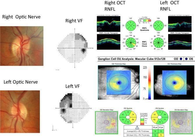 A multi-modal neuro-ophthalmic assessment of a patient with chiasmal compression. The composite includes fundus photographs, Humphrey visual field (VF) tests, and Optical Coherence Tomography (OCT) of the Retinal Nerve Fiber Layer (RNFL) and Ganglion Cell Layer (GCL). The fundus photographs of the right and left optic nerves show a clinically normal appearance with healthy disc margins and vasculature. Automated perimetry (VF) reveals a classic bitemporal hemianopia, characterized by significant sensitivity loss in the temporal hemifields of both eyes. The OCT RNFL thickness maps and circular tomograms appear largely within normal limits (coded green in quadrant/clock-hour maps), indicating minimal retrograde axonal loss at the disc level. However, the Ganglion Cell Analysis (GCL+IPL) thickness and deviation maps demonstrate clear 'binasal' macular thinning that respects the vertical midline, corresponding to the temporal visual field defects. This clinical scenario illustrates that macular GCL thinning can precede detectable RNFL atrophy in chronic compressive chiasmopathy, such as that caused by a pituitary adenoma.