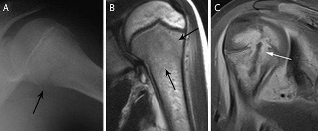 This composite figure illustrates the radiological presentation of acute pediatric hematogenous osteomyelitis in the proximal humerus across different modalities. Panel A is a plain radiograph showing a subtle osteolytic lesion in the metaphysis with early cortical blurring and loss of delineation at the medial aspect (black arrow). Panel B presents a coronal T2-weighted MRI showing hyperintense bone marrow edema (black arrows) primarily localized to the metaphyseal region. Panel C displays a coronal T1-weighted post-gadolinium contrast image with fat saturation, revealing a rim-enhancing intra-osseous abscess (white arrow). This image highlights transphyseal spread, where the infection has crossed the growth plate to involve the epiphysis, a critical finding in pediatric musculoskeletal imaging. These panels collectively demonstrate the evolution of findings from subtle radiographic changes to advanced abscess formation and epiphyseal extension, emphasizing the high sensitivity of MRI for detecting bone marrow changes and identifying surgical targets like rim-enhancing collections.