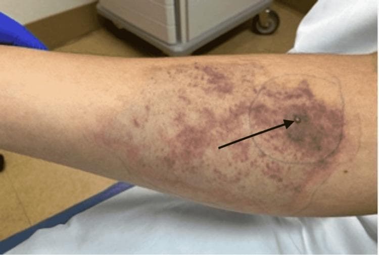 This clinical photograph displays a characteristic skin lesion resulting from a brown recluse spider (Loxosceles reclusa) bite on an extremity. The primary lesion consists of a central tense vesicle (indicated by a black arrow) resting upon an area of developing cutaneous necrosis, presenting as a darkened, dusky induration. Surrounding this central point is a large, irregularly shaped region of mixed ecchymosis and gravitational spreading of erythema. The discoloration demonstrates the classic 'red, white, and blue' sign associated with loxoscelism: peripheral erythema (red), intermediate blanching or ischemia (white), and central hemorrhagic necrosis (blue/purple). A pen-marked circle outlines the immediate inflammatory reaction to monitor progression. This image serves as an educational example of loxoscelism-induced skin changes, illustrating local tissue destruction and the typical inflammatory response involving vasospasm and thrombosis.