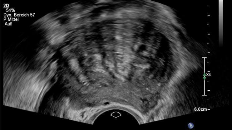 This diagnostic transvaginal ultrasound image displays a sagittal view of a uterus demonstrating classic sonographic features of adenomyosis, classified here under the #Enzian(u)FA category. Key visible findings include a significant global enlargement of the uterus with a marked asymmetry between the anterior and posterior myometrial walls. The myometrial texture is heterogeneous, exhibiting mixed echogenicity with several scattered small anechoic cystic areas (intramyometrial cysts) and bright hyperechogenic islands. A pathognomonic 'fan-shaped' or 'rain-shower' shadowing pattern is evident, where vertical stripes of acoustic shadowing originate from the heterogeneous tissue, obscuring deeper structures. The endo-myometrial junction appears blurred or ill-defined. These features are essential for the non-invasive diagnosis of uterine adenomyosis and are used to differentiate it from other pathologies like leiomyomas. The image serves as an educational tool for identifying Morphological Uterine Sonographic Assessment (MUSA) criteria in gynecological imaging.