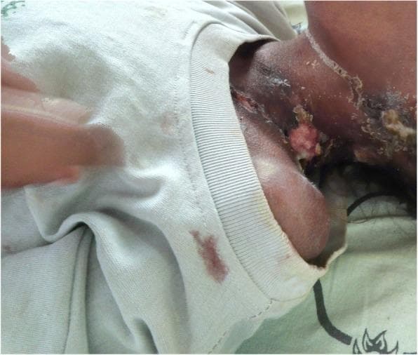 Clinical photograph of the left lateral neck and supraclavicular region of a patient, demonstrating classic features of scrofuloderma (cutaneous tuberculosis). The image shows multiple matted, enlarged cervical lymph nodes that have progressed to involve the overlying skin. Key visible findings include irregular skin ulcerations with undermined borders, friable granulation tissue, and active purulent drainage of a yellowish-white consistency. Distinctive draining sinus tracts are visible, along with thick, dark-colored crusts and scabs adjacent to the open lesions. The surrounding skin exhibits inflammatory changes, including erythema and hyperpigmentation. This presentation illustrates the progression of tuberculous lymphadenitis (scrofula) where the infection extends from deeper lymphatic structures to the cutaneous surface, resulting in chronic ulceration and cold abscess formation.
