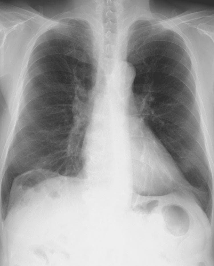 This diagnostic image is a posteroanterior (PA) chest X-ray demonstrating classic radiographic features of Chronic Obstructive Pulmonary Disease (COPD) and pulmonary emphysema. The lungs exhibit marked hyperinflation, characterized by an increased lung volume and a vertical orientation of the heart (narrowed cardiac silhouette). Key anatomical findings include significant bilateral flattening of the diaphragmatic domes and an increased number of visible anterior ribs (greater than seven), indicating air trapping. There is a notable pruning of the peripheral pulmonary vascular markings, with increased lucency in the lung fields suggestive of parenchymal destruction. The mediastinum appears relatively narrow, and the hilar structures are prominent. These findings are clinically significant as they illustrate the mechanical disadvantages placed on respiratory muscles due to chronic hyperinflation and decreased elastic recoil. The image serves as a textbook example for medical students and clinicians to identify obstructive lung disease manifestations on plain film radiography.