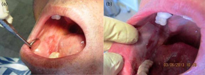 Two-panel clinical photograph demonstrating intraoral imaging and the application of a drug delivery system. Panel (a) shows the oral cavity being examined with a metallic circular dental mirror. The mirror is retracting the buccal mucosa to reveal an erythematous, mottled lesion with raised textures and irregular borders on the internal cheek surface, consistent with oral inflammatory or ulcerative conditions. Panel (b) illustrates the clinical application of a translucent, rectangular mucoadhesive patch (containing 2% Mycophenolate Mofetil) placed directly over the affected mucosal tissue. A gloved hand provides cheek retraction for clear visualization. The patch appears thin and well-adhered to the moist oral surface, positioned near the maxillary teeth. These images demonstrate a therapeutic protocol for localized treatment of oral mucosal lesions, highlighting the preparation phase (mouth breathing to dry the site) and the subsequent one-minute post-application adherence of the polymeric drug-delivery film.