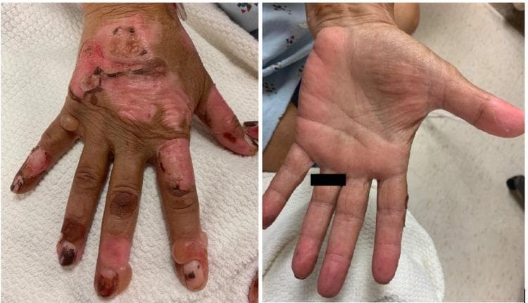 This clinical photograph displays a side-by-side comparison of the dorsal and palmar surfaces of a human hand, illustrating a bullous dermatosis. The left image (dorsal view) shows significant pathology characterized by multiple, large, tense bullae of varying sizes localized to the dorsum of the hand and fingers. Several bullae have ruptured, revealing raw, erythematous bases with overlying crusting and superficial erosions. The surrounding skin exhibits hyperpigmentation and signs of chronic inflammation or scarring. In contrast, the right image (palmar view) demonstrates a relative sparing of the palmar surface, which remains largely intact without visible blisters or erosions. This distribution—blisters on sun-exposed dorsal areas with palmar sparing—is a hallmark of porphyria cutanea tarda (PCT) or pseudoporphyria, often seen in the context of chronic kidney disease and hemodialysis. The clinical significance lies in demonstrating the photosensitive nature of these skin lesions and the typical morphological findings of fluid-filled vesicles and bullae on fragile, sun-exposed skin.