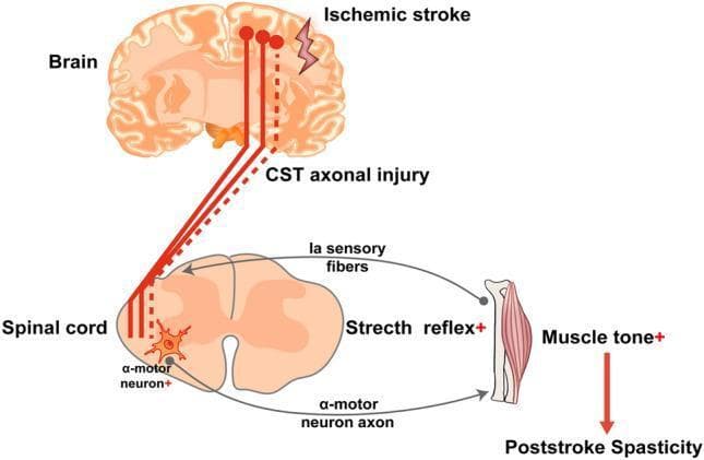 A pathophysiology diagram illustrating the mechanisms of post-stroke spasticity (PSS) involving the corticospinal tract (CST) and the spinal stretch reflex arc. The diagram is divided into three main levels: the brain, the spinal cord, and the effector muscle. In the brain, an ischemic stroke is depicted, leading to CST axonal injury, represented by solid red lines transitioning into a dashed red line to signify disrupted descending signals. At the spinal cord level, the diagram shows the interaction between the damaged CST and the lower motor neurons. The stretch reflex arc is highlighted, featuring Ia sensory fibers from the muscle spindle synapsing onto an alpha-motor neuron in the anterior horn. A '+' sign next to the alpha-motor neuron and the stretch reflex indicates abnormal hyperexcitability and hyperreflexia due to the loss of descending inhibitory control from the CST. The pathway concludes at the skeletal muscle, where increased muscle tone (+) is indicated, leading to the clinical manifestation of post-stroke spasticity. The illustration serves as an educational tool for neurology and physical medicine, demonstrating the upper motor neuron lesion model.