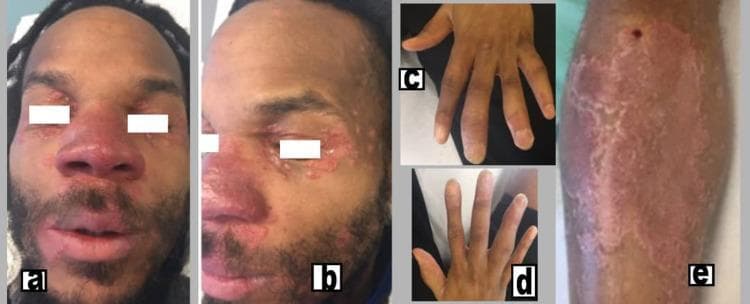 This composite clinical photograph displays the multi-systemic cutaneous and musculoskeletal manifestations of chronic sarcoidosis. Figures (a) and (b) show the patient's face with characteristic lupus pernio, presenting as indurated, violaceous (purplish) plaques and nodules affecting the nose, cheeks, and periorbital regions. Figure (e) illustrates a large, well-demarcated, erythematous to purplish indurated plaque on the medial aspect of the right leg. Figures (c) and (d) demonstrate clinical dactylitis ('sausage digits') of the hands, characterized by diffuse swelling of the fingers involving the proximal interphalangeal (PIP) and distal interphalangeal (DIP) joints. The image serves as an educational resource for identifying the classic visual signs of sarcoidosis, specifically the association between lupus pernio skin lesions and sarcoid dactylitis or inflammatory arthritis. It is intended for medical students and clinicians specializing in dermatology and rheumatology.