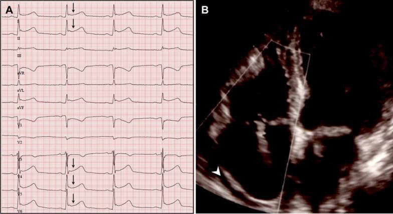 This composite diagnostic image illustrates clinical findings associated with post-cardiac injury syndrome (PCIS) following radiofrequency ablation. Panel A shows a 12-lead electrocardiogram (ECG) demonstrating widespread, saddle-shaped ST-segment elevations, most prominently visible in the lateral and inferior leads (I, II, aVL, and V4-V6), indicated by black arrows. These findings are characteristic of acute pericarditis. Panel B presents a transthoracic echocardiogram in a four-chamber view, where a white arrowhead points to a dark, echo-free space surrounding the cardiac chambers. This represents a circumferential pericardial effusion. Together, these panels provide a clinical correlation between electrical abnormalities (diffuse ST elevation) and structural pathology (fluid in the pericardial space) in the context of post-procedural cardiac inflammation. The content is suitable for medical education regarding complications of cardiac interventions and the diagnosis of acute pericarditis.